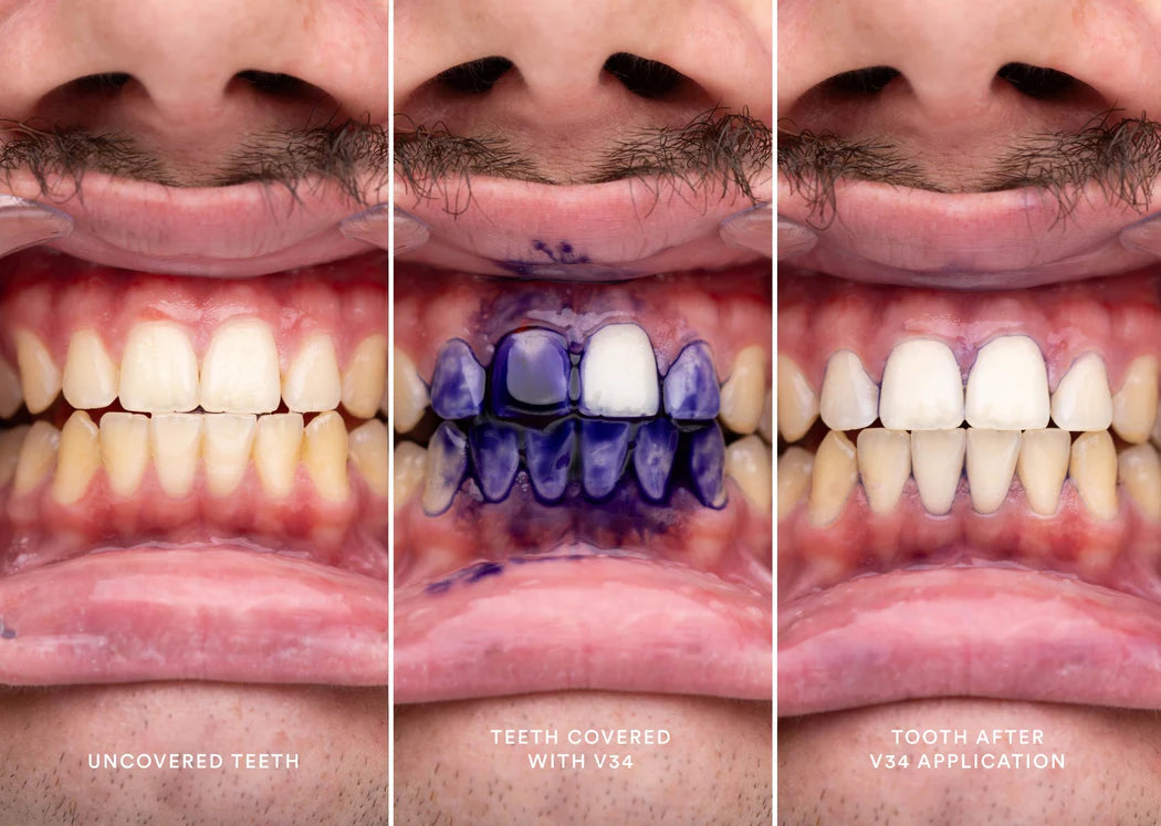 HiSmile BrightSmile Corrector.